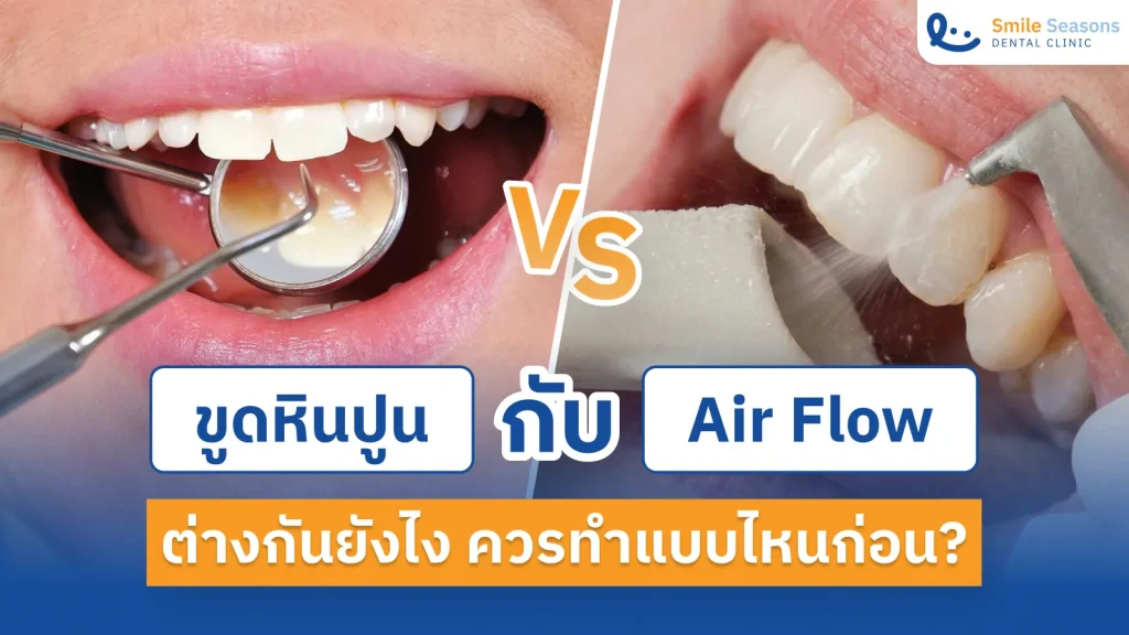 Air Flow กับ ขูดหินปูน ต่างกันยังไง ควรทำแบบไหนก่อน