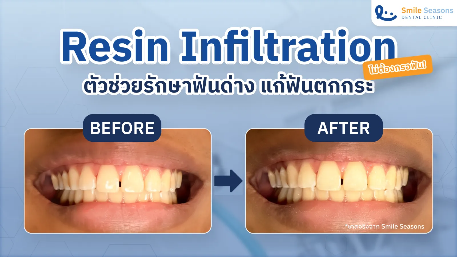 Resin Infiltration ตัวช่วยรักษาฟันด่าง แก้ฟันตกกระ