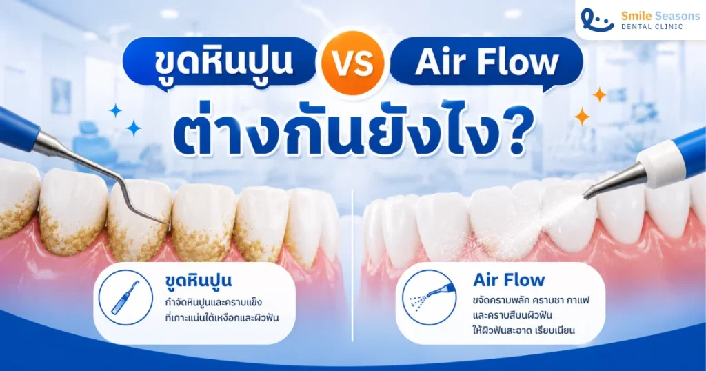 Air Flow กับ ขูดหินปูน ต่างกันยังไง? ควรทำแบบไหนก่อนกัน