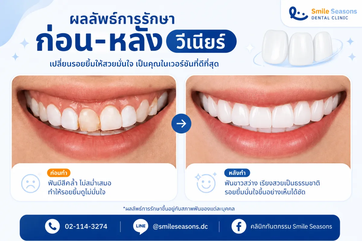 ตัวอย่างก่อนและหลังทำวีเนียร์เพื่อวางแผนจำนวนซี่