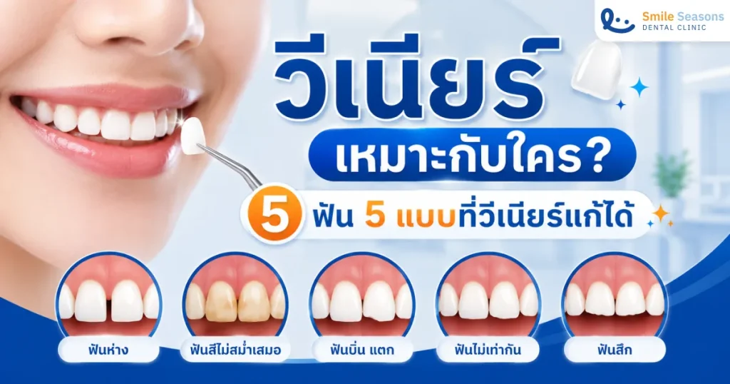 วีเนียร์ เหมาะกับใคร ฟัน 5 แบบที่วีเนียร์แก้ได้ จบปัญหาฟันห่าง ฟันเหลือง