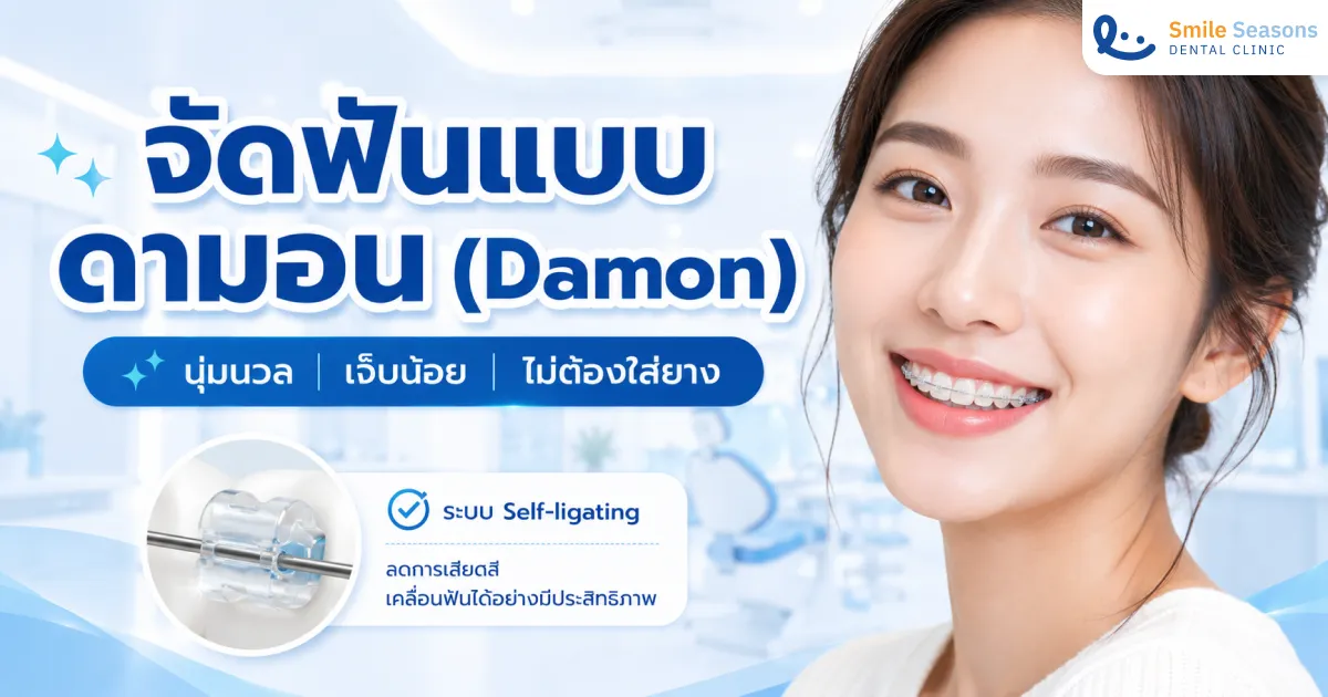 การจัดฟันแบบดามอน (Damon) ไม่ต้องใส่ยาง เจ็บน้อยกว่า