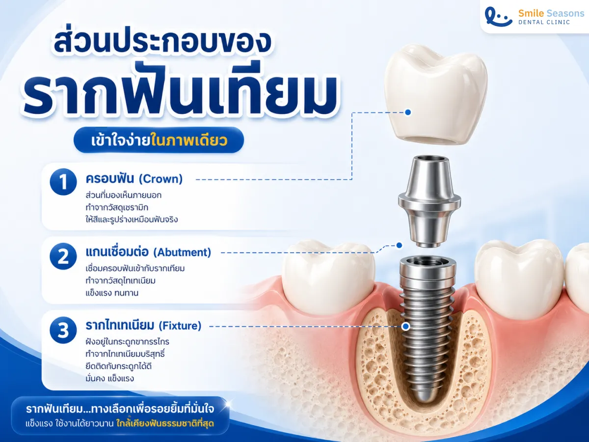 โครงสร้างรากฟันเทียม 3 ส่วน ประกอบด้วย ครอบฟัน แกนรองรับ และรากไทเทเนียม