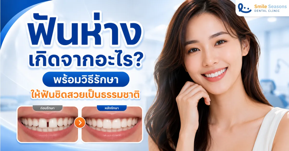 ฟันห่าง เกิดจากอะไร พร้อมวิธีรักษาให้ฟันชิดสวยเป็นธรรมชาติ