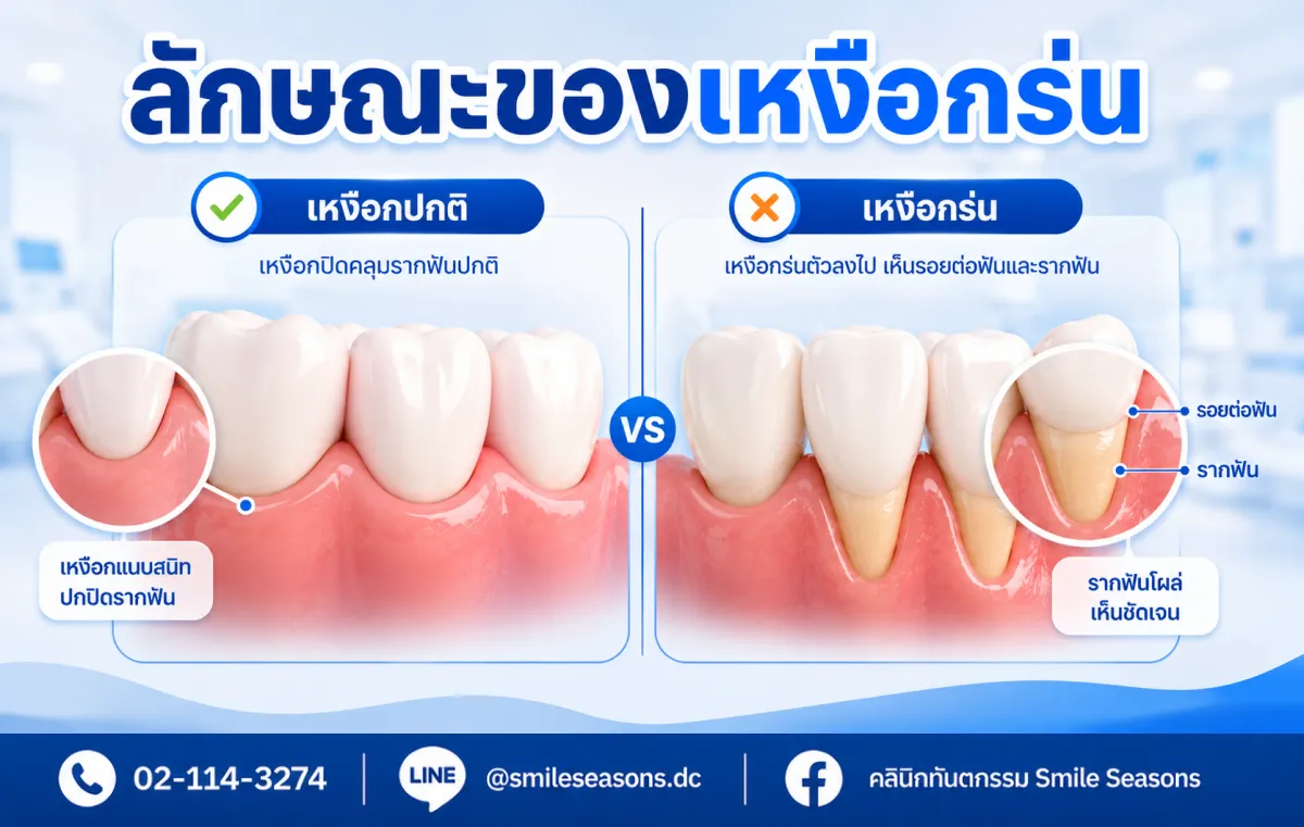 เปรียบเทียบฟันปกติและภาวะเหงือกร่น Smile Seasons Dental Clinic