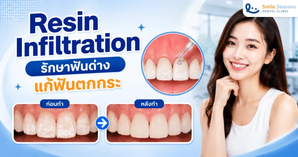 Resin Infiltration รักษาฟันด่าง แก้ฟันตกกระ ไม่ต้องกรอฟัน