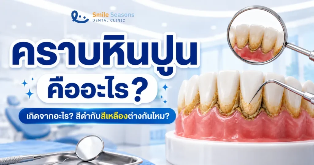 คราบหินปูน คืออะไร เกิดจากอะไร สีดำสีเหลืองต่างไหม 2026