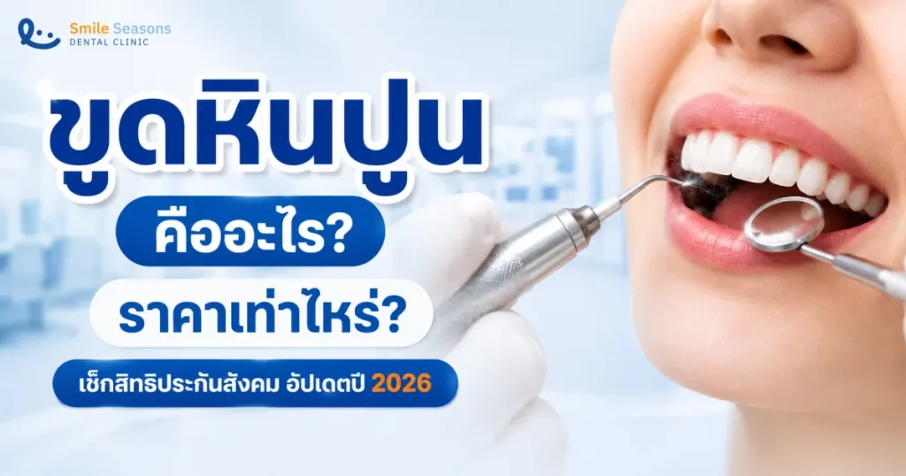 ขูดหินปูน คืออะไร? ราคาเท่าไหร่ เช็กสิทธิประกันสังคมอัปเดตปี 2026