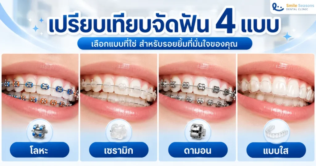 จัดฟันมีกี่แบบ? เทียบ 4 แบบ ราคา ข้อดีข้อเสีย อัปเดต 2569