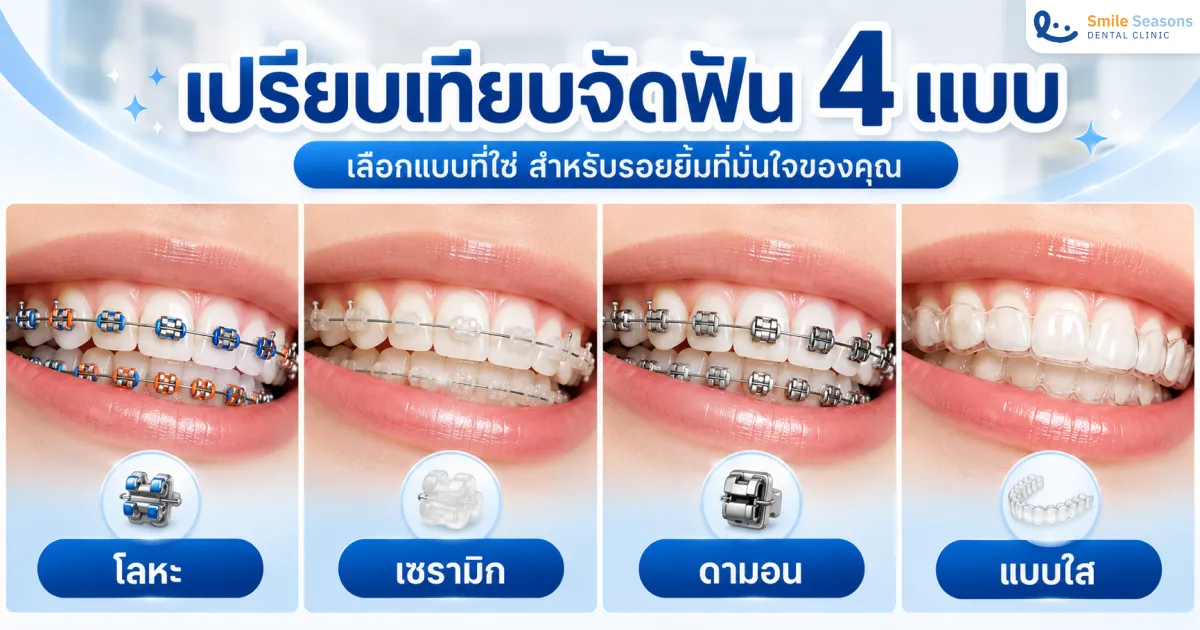 จัดฟันมีกี่แบบ? เทียบ 4 แบบ ราคา ข้อดีข้อเสีย อัปเดต 2569