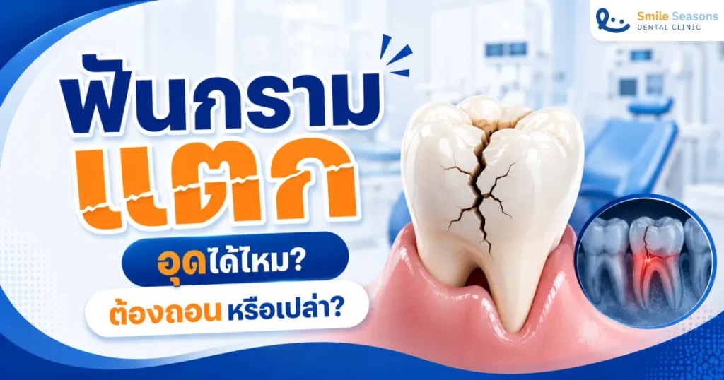 ฟันกรามแตก อุดได้ไหม ต้องถอนหรือเปล่า วิธีรักษาและราคา