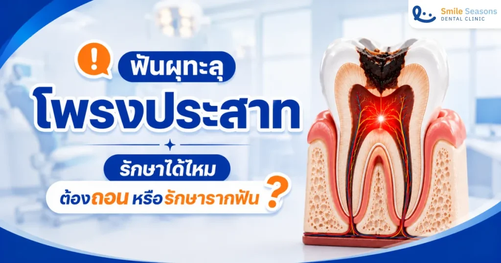 ฟันผุทะลุโพรงประสาท รักษาได้ไหม ต้องถอนหรือรักษารากฟัน