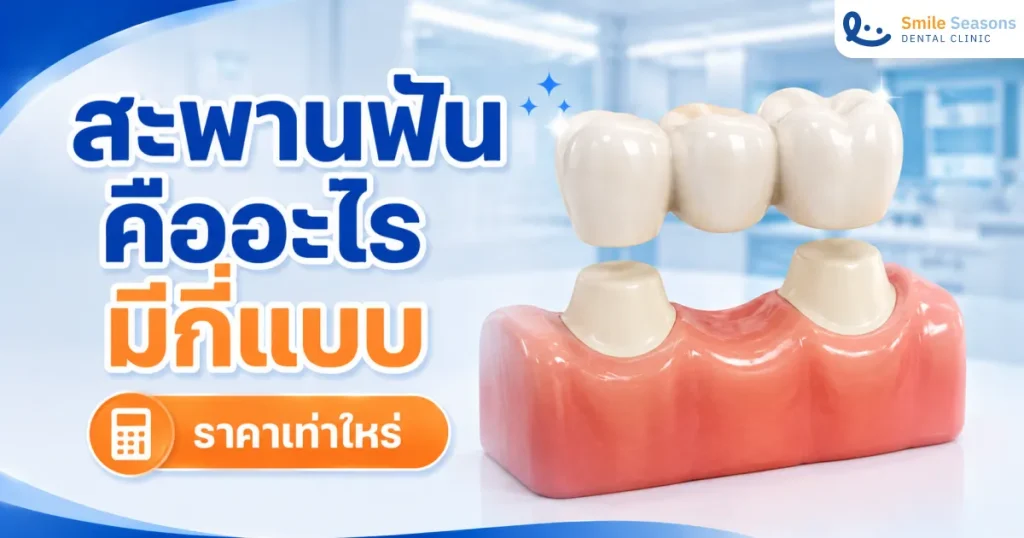 สะพานฟันคืออะไร มีกี่แบบ ราคาเท่าไหร่ อยู่ได้กี่ปี