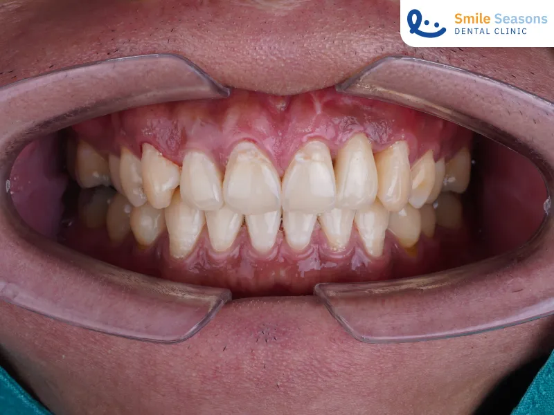 ผลลัพธ์ช่องปากคนไข้หลังทำรากฟันเทียมที่ Smile Seasons Dental Clinic