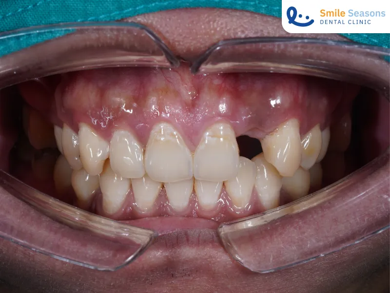 สภาพช่องปากคนไข้ก่อนทำรากฟันเทียมที่ Smile Seasons Dental Clinic