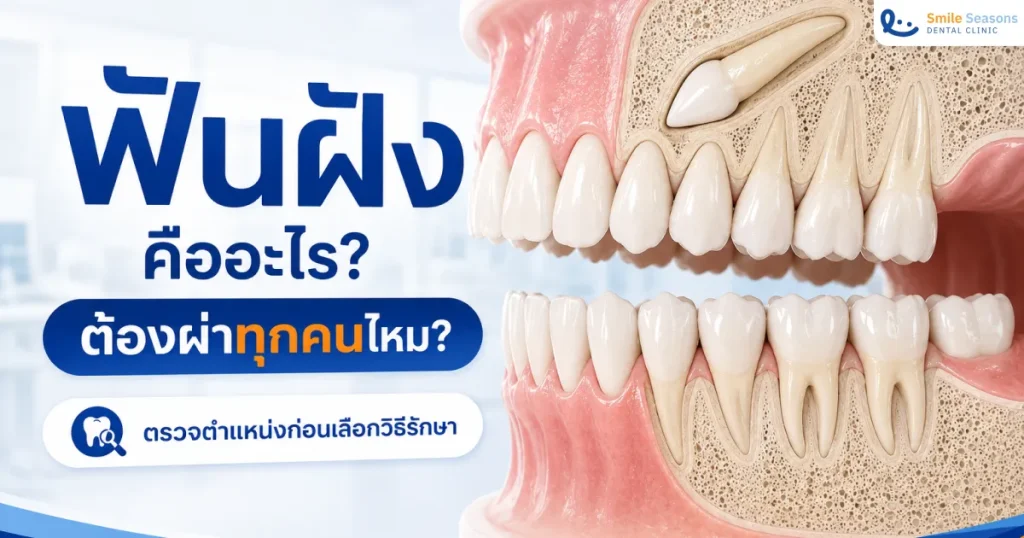 ฟันฝัง คืออะไร? ต้องผ่าไหม เช็กอาการ วิธีรักษาและราคา