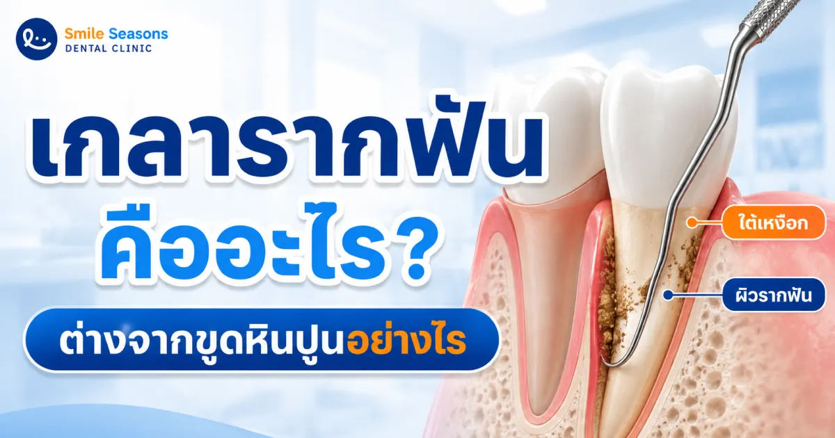 เกลารากฟัน คืออะไร? เจ็บไหม ต่างจากขูดหินปูนอย่างไร