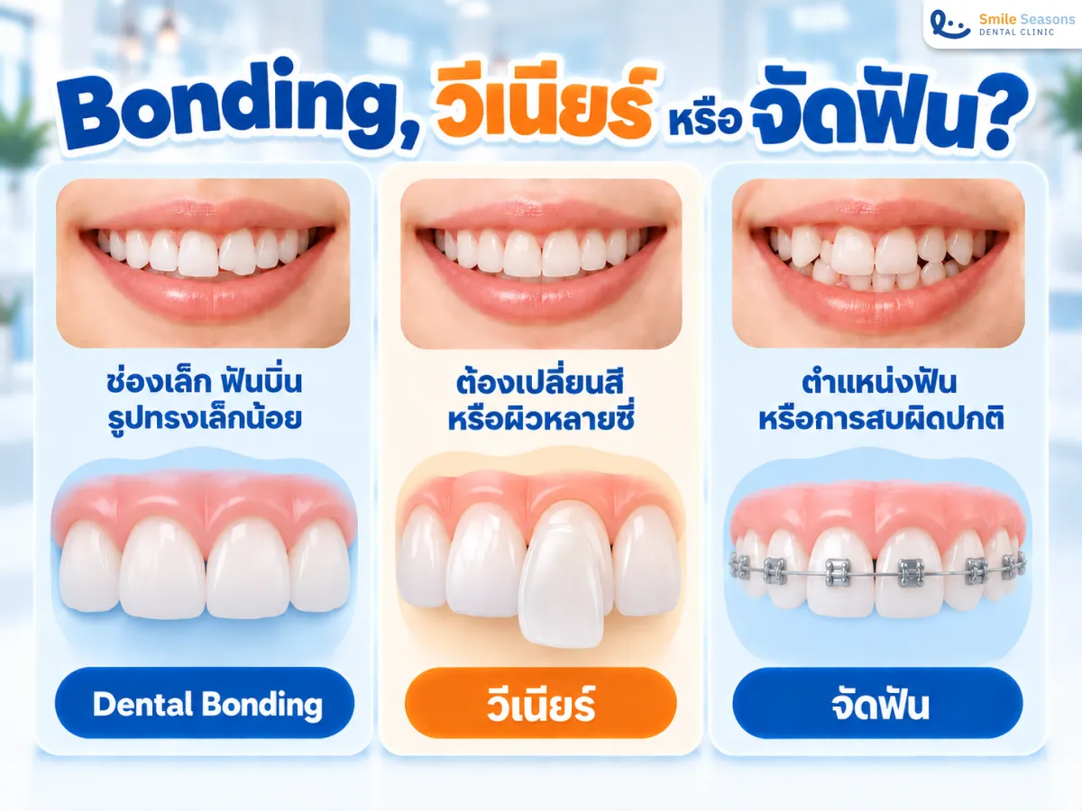 แนวทางเลือก Dental bonding วีเนียร์ หรือจัดฟันที่ Smile Seasons