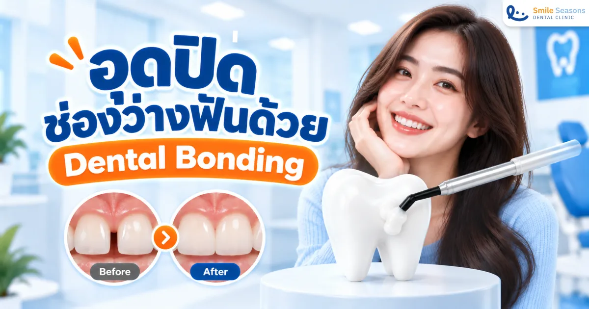 อุดปิดช่องว่างฟันด้วย Dental Bonding ดีไหม?