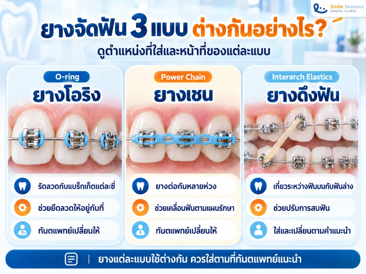 เปรียบเทียบตำแหน่งและหน้าที่ของยางโอริง ยางเชน และยางดึงฟัน