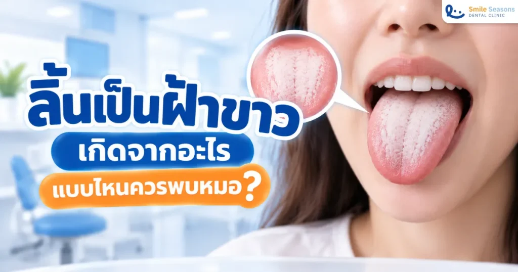 ลิ้นเป็นฝ้าขาว เกิดจากอะไร แบบไหนควรพบหมอ 2026