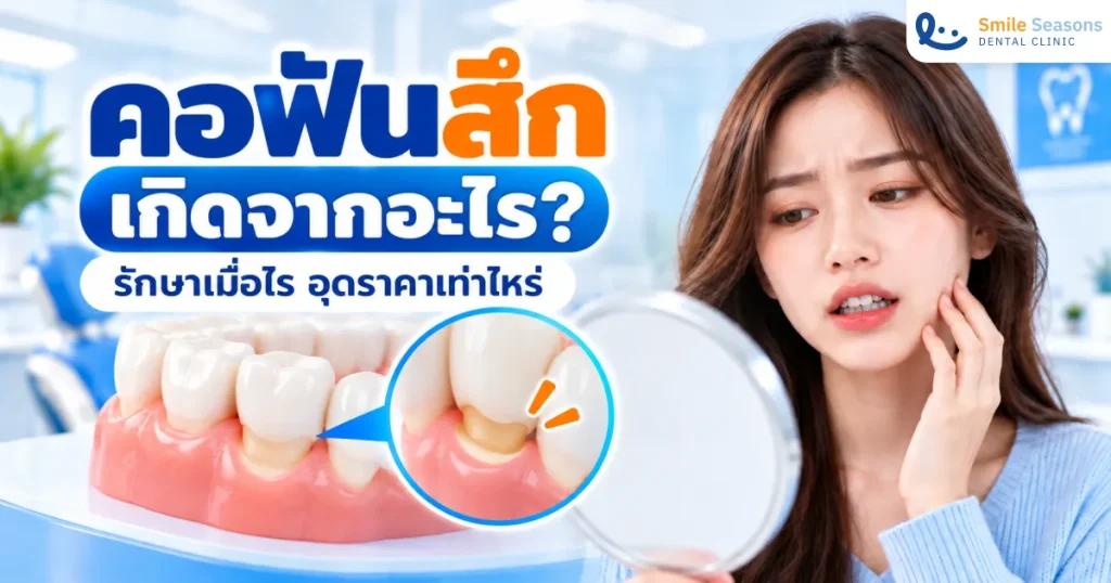 คอฟันสึกคืออะไร สาเหตุ วิธีรักษา และราคาอุด 2026