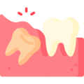 wisdom tooth extraction